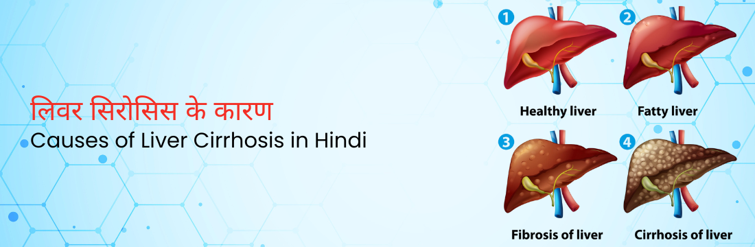  लिवर सिरोसिस के कारण